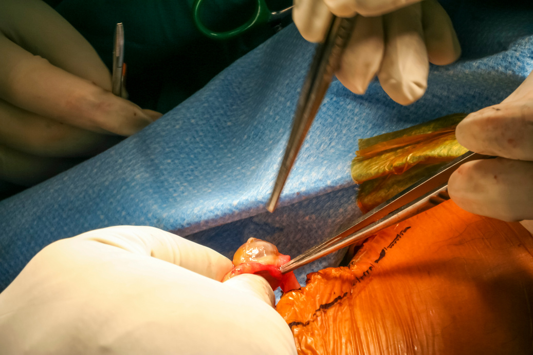 Nerve tumor disection during the surgery